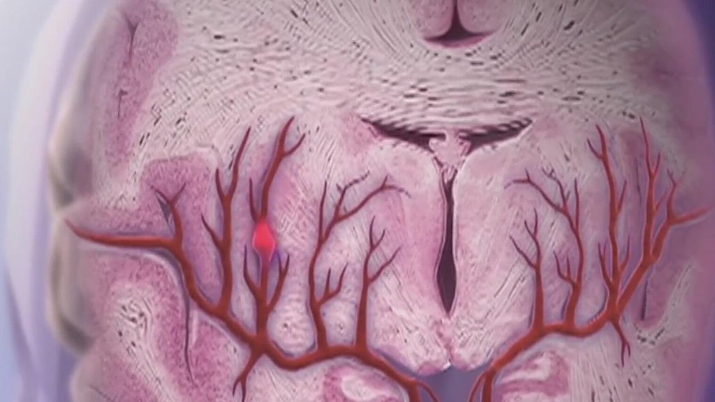 Knowing the signs of a stroke can save lives — Kennesaw Community news
